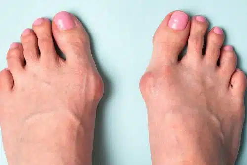 Comment redresser un hallux valgus ?