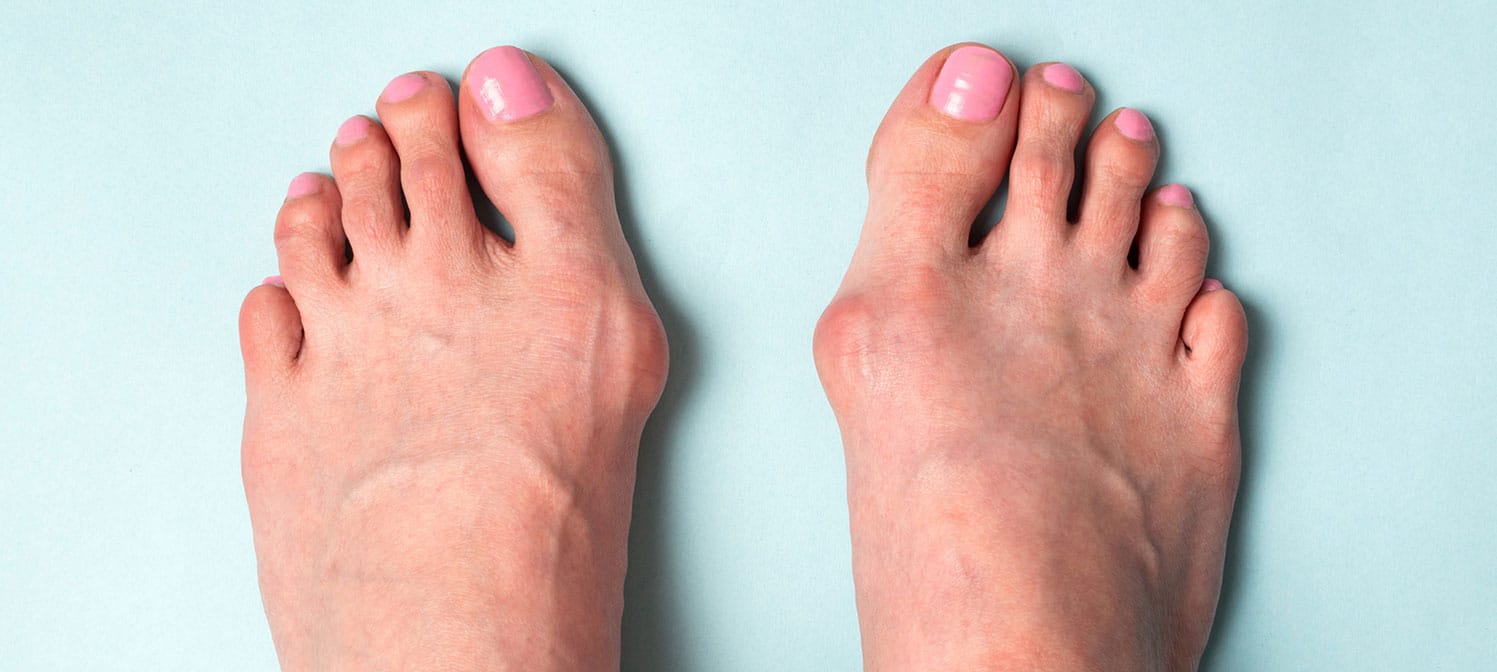 Comment redresser un hallux valgus ?