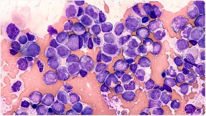 Comment éviter le cancer du sang ?