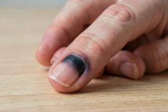 Gros plan sur un ongle avec une tache noire sous-unguéale après un choc, hématome visible sous l'ongle d'un doigt adulte